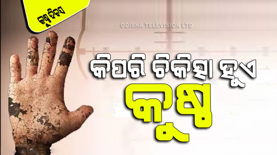 World Leprosy Day 2024: କୁଷ୍ଠ ନୁହେଁ ଦୂରାରୋଗ୍ୟ; ଜାଣନ୍ତୁ କିପରି ହୁଏ ଏହାର ଚିକିତ୍ସା