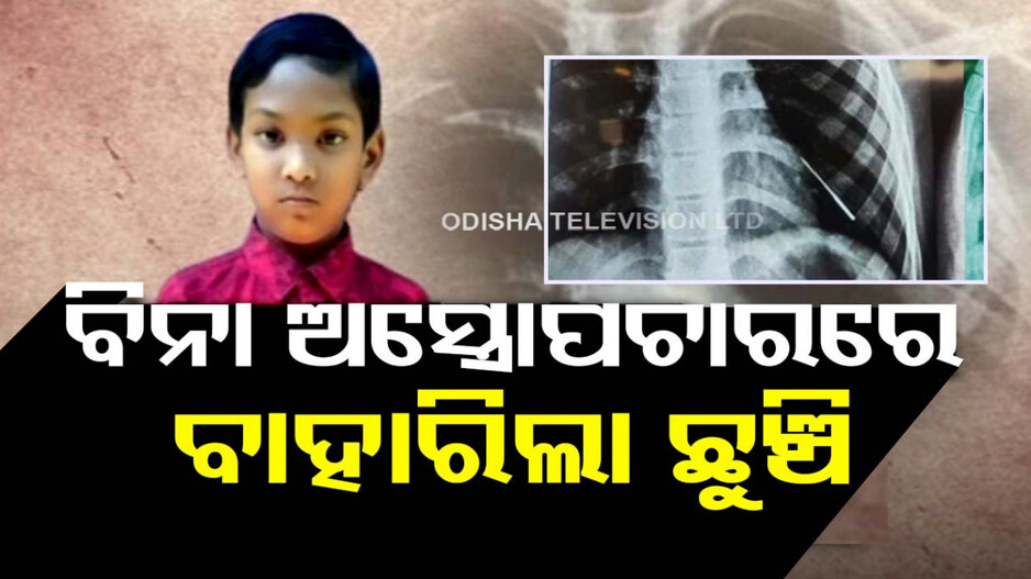 ଜିତିଲା ଚିକିତ୍ସା ବିଜ୍ଞାନ, ୯ ବର୍ଷର ପିଲାକୁ ନୂଆ ଜୀବନ ଦେଲା ଭୁବନେଶ୍ୱର ଏମ୍ସ