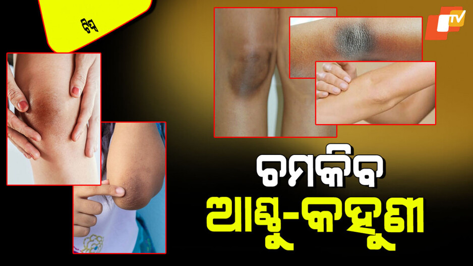 Tips and Tricks: ଆପଣଙ୍କ କହୁଣୀ ଏବଂ ଆଣ୍ଠୁ କଳା ପଡୁଛି କି… ମାନନ୍ତୁ ଏହି ଟିପ୍ସ, କିଛି ସମୟରେ ଚମକିବ