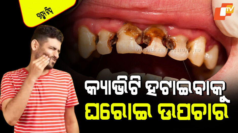 Dental Care Tips: ୪ ସହଜ ଉପାୟ; ଦାନ୍ତରେ ରହିବ ନାହିଁ କ୍ୟାଭିଟି, ପୋକ ଖାଉଥିଲେ ଭଲ ହେଇଯିବ