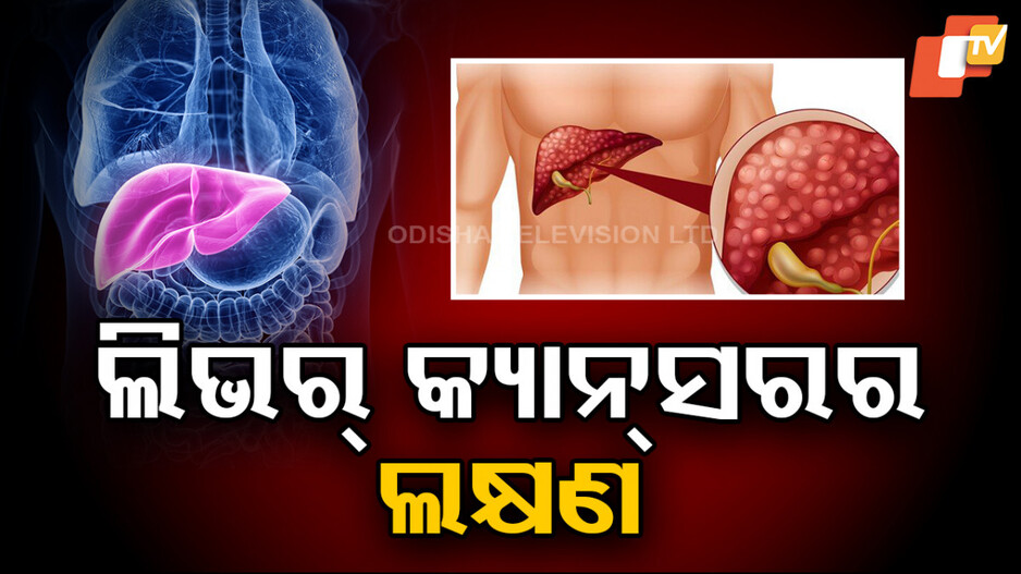Sign Of Liver Cancer: ଏହି ଲକ୍ଷଣର ନିଅନ୍ତୁ ଯତ୍ନ, ଆଉ ହେବ ନାହିଁ ଲିଭର୍ କ୍ୟାନ୍ସର !