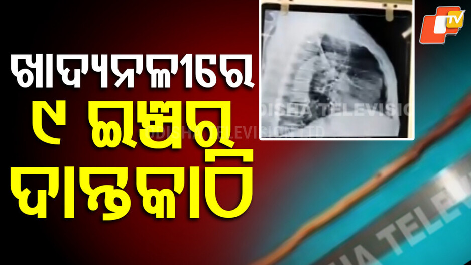 ଖାଦ୍ୟନଳୀରୁ ବାହାରିଲା ଦାନ୍ତକାଠି