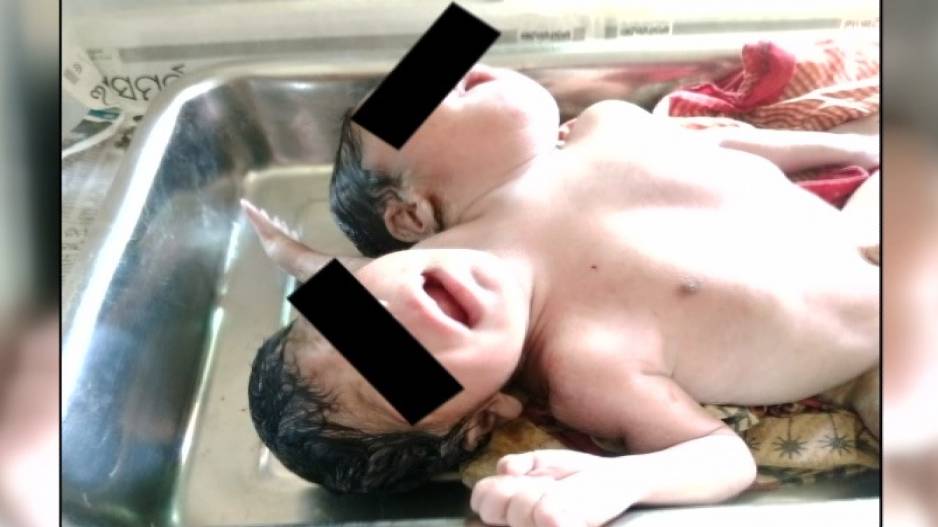 Two-Headed Baby Girl Of Odisha