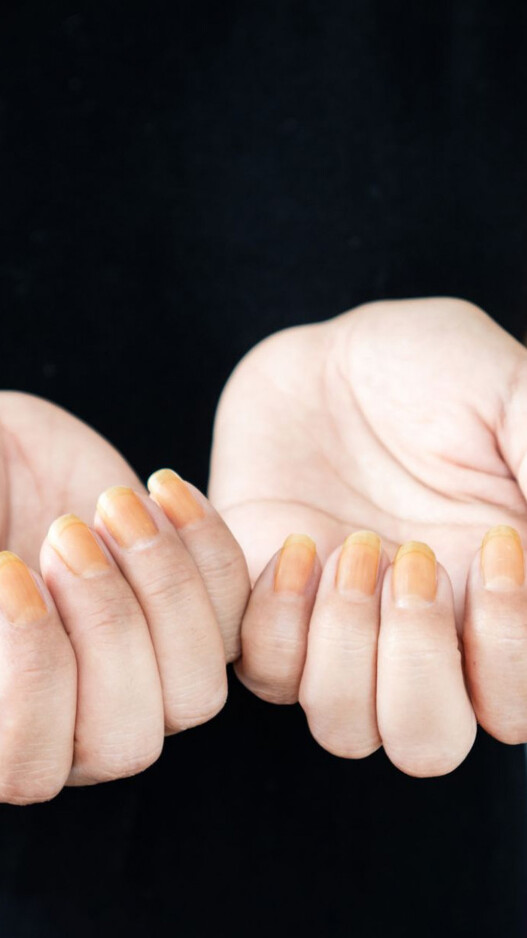 6 tips to prevent nail yellowing and staining after removing nail polish