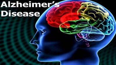 Alzheimer-disease