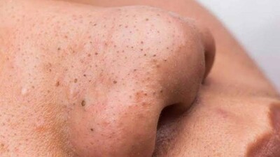 Blackheads