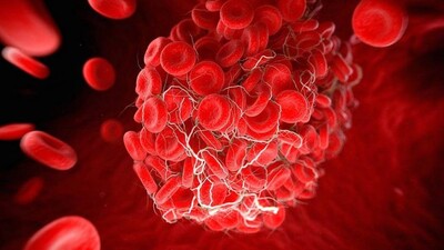 Blood Clot