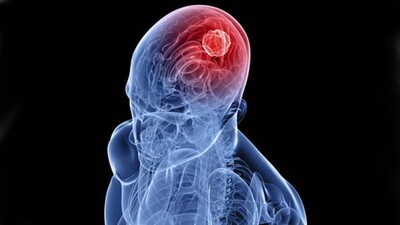 Brain-Cancer