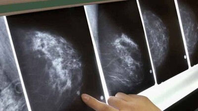 Google-AI-dtects-cancer