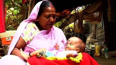 Hydrocephalus-Hit-Baby-In-O