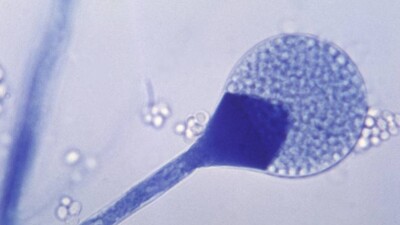 Covid Black Fungus