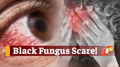 Black fungus - Mucormycosis causes and treatment