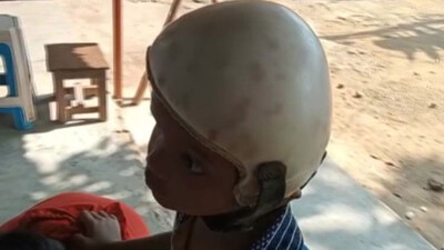 Separated Conjoined Twin Jaga