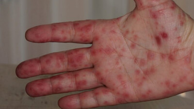 Suspected Tomato Flu Patient
