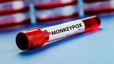 Monkeypox