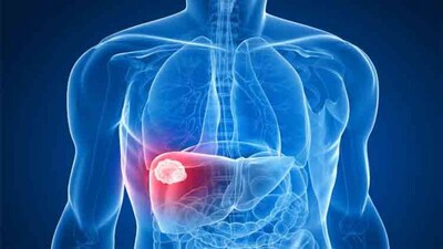 Liver-cancer-gut-microbiota
