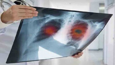 Lung-Cancer