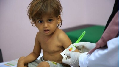 Malnourished-Children