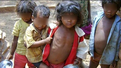 Centre Asks Odisha, Other States To Refer Severe Malnutrition Cases To Hospitals
