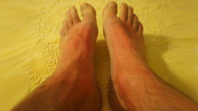 Skin-Cancer