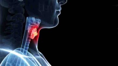 Throat-Cancer