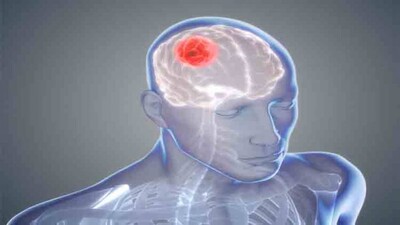 brain-cancer