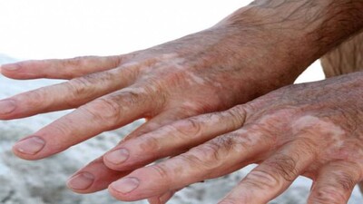 leucoderma
