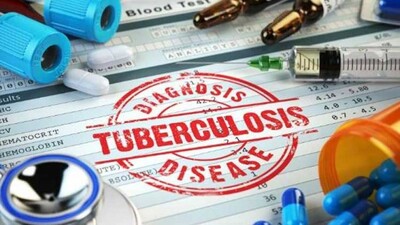tuberculosis
