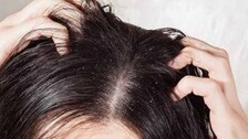 Dandruff