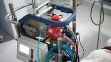 After SCB, ECMO Machine To Be Installed At Capital Hospital In Bhubaneswar