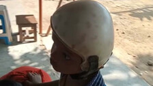 Separated Conjoined Twin Jaga