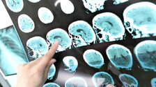 Brain Stroke