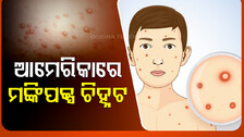 ୟୁରୋପ୍‌ ପରେ ମଙ୍କିପକ୍ସ ଜାଲରେ ଆମେରିକା